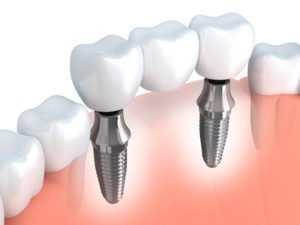 Dental implant