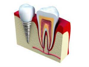 3D and cut through of a dental implant next to a real tough to compare 
