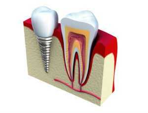 3D and cut through of a dental implant next to a real tough to compare