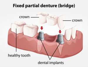 3d rendering of an bridge supported implant used to compare options to patients.