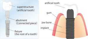 Diagram of the parts of a dental implant and the jaw. 