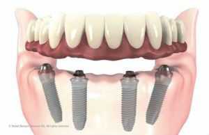 3D rendering of how a fixed denture appliance is installed into the jaw. 