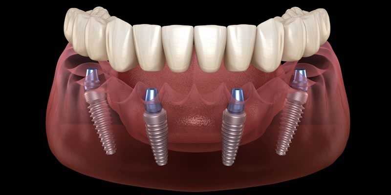 All-on-4 Implants