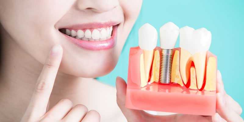 Dental Implants