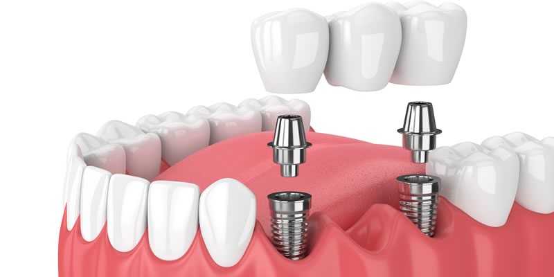 Multiple Dental Implants