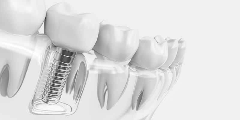 Single Dental Implant